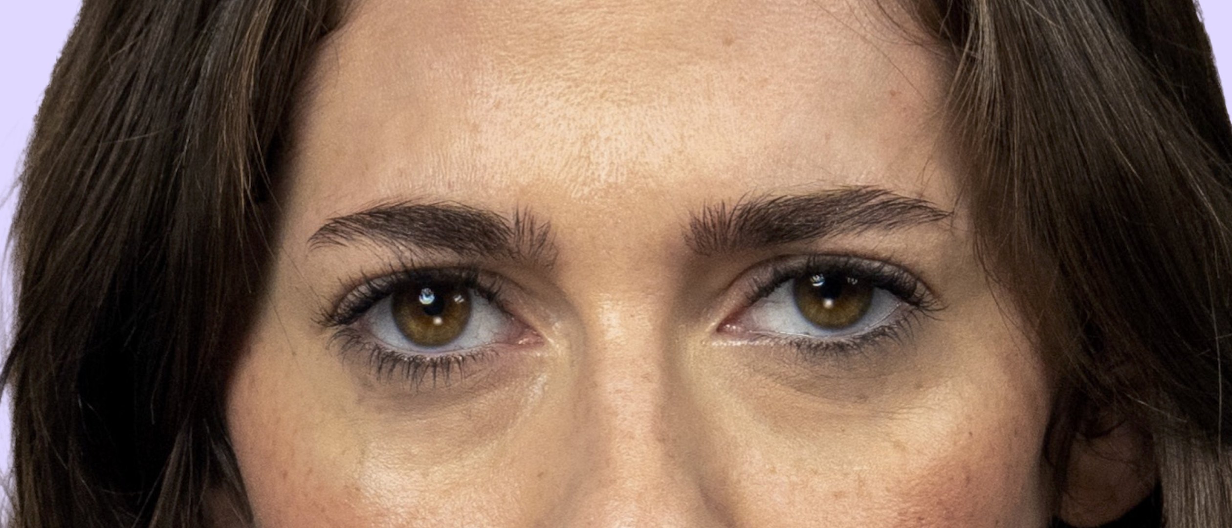 Tara 3 days after Letybo treatment
