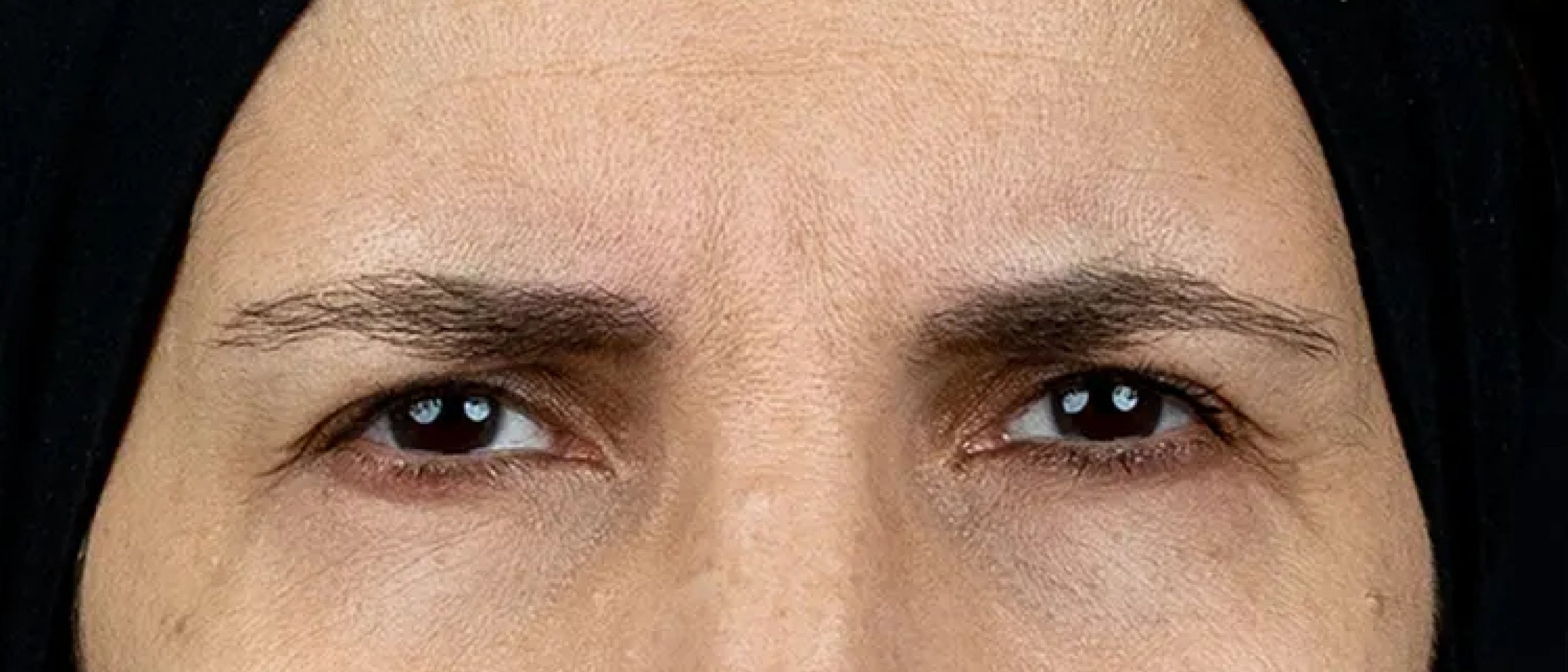 Patient 4 months after Letybo treatment